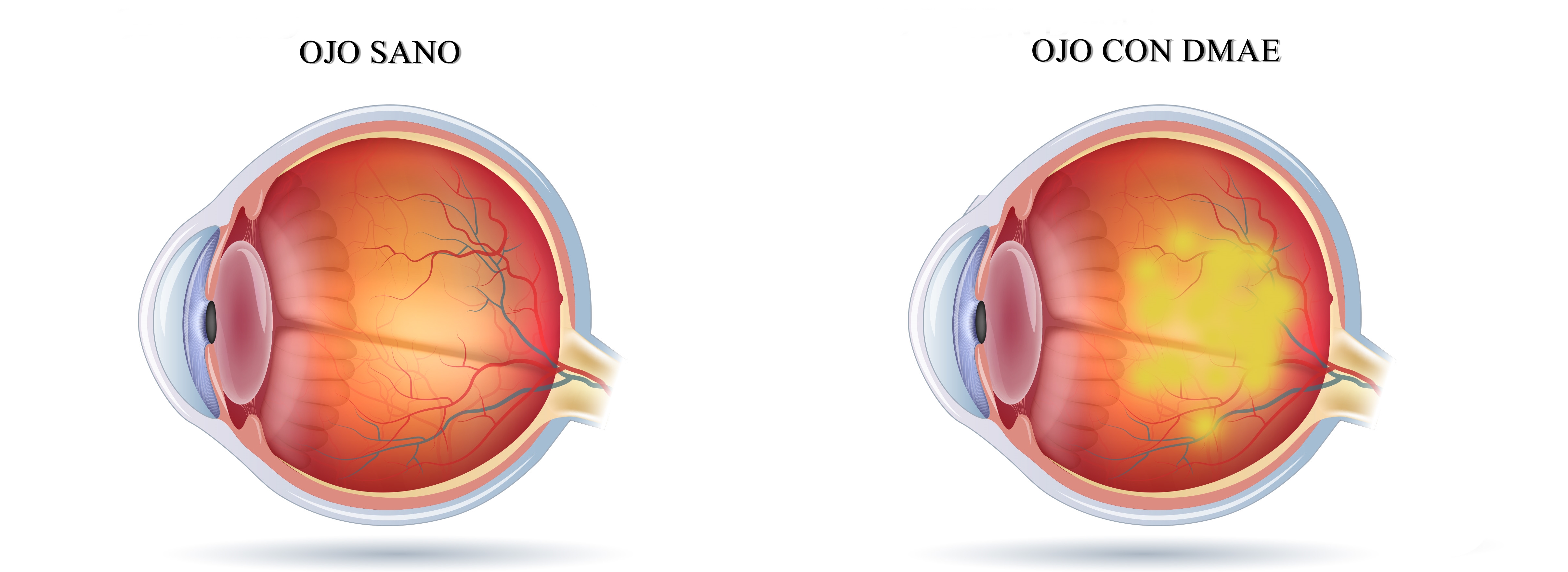 ¿Qué es la degeneración macular relacionada con la edad?